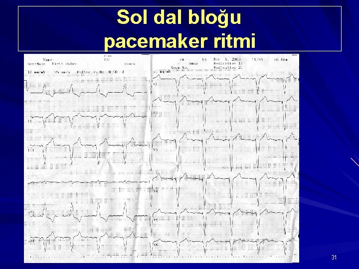 Sol dal bloğu pacemaker ritmi 31 