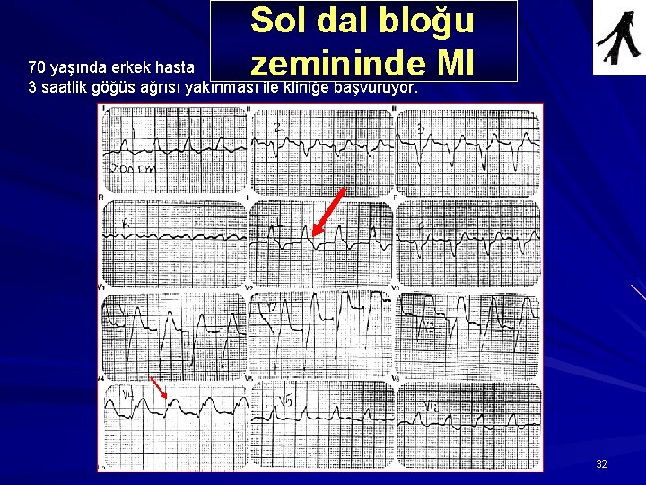 Sol dal bloğu Olgu 6 70 yaşında erkek hasta zemininde MI 3 saatlik göğüs