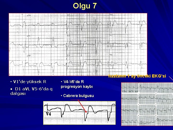 Olgu 7 hastanın 1 ay önceki EKG’si • V 1’de yüksek R • V