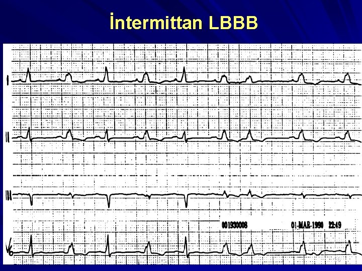 İntermittan LBBB 36 