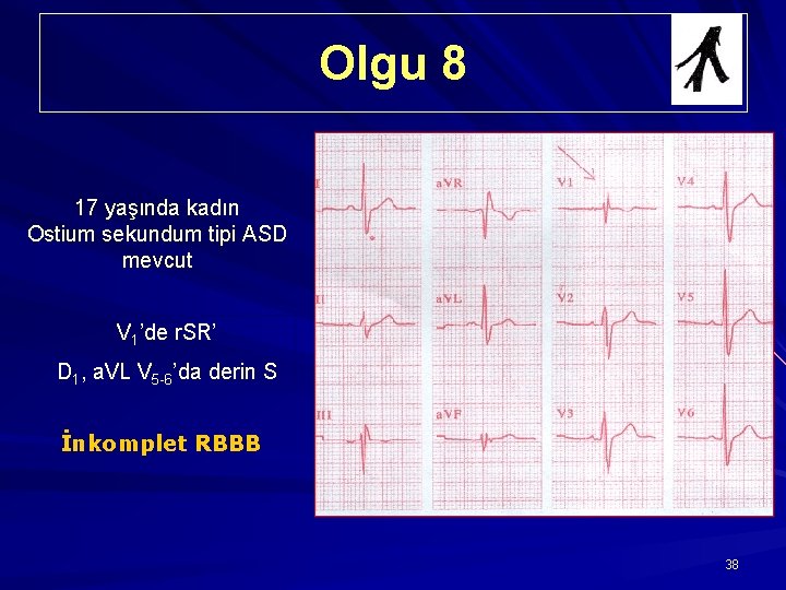 Olgu 8 17 yaşında kadın Ostium sekundum tipi ASD mevcut V 1’de r. SR’