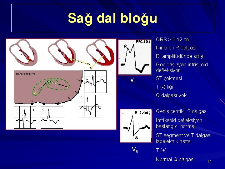 Sağ dal bloğu QRS > 0. 12 sn İkinci bir R dalgası R’ amplitüdünde