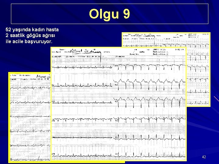 Olgu 9 52 yaşında kadın hasta 2 saatlik göğüs ağrısı ile acile başvuruyor. MI