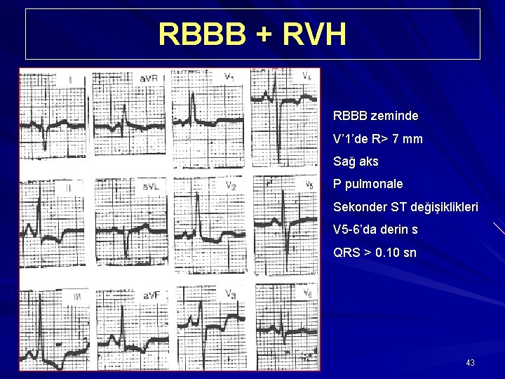 RBBB + RVH RBBB zeminde V’ 1’de R> 7 mm Sağ aks P pulmonale