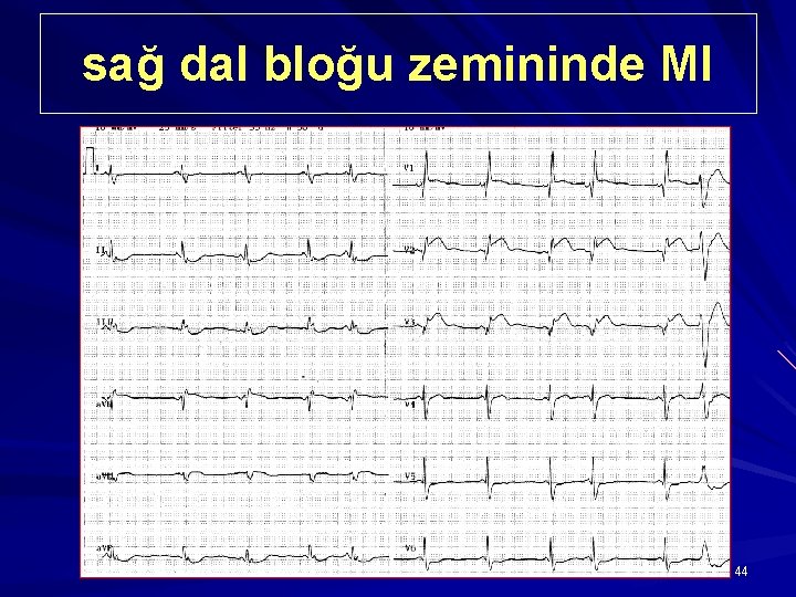 sağ dal bloğu zemininde MI 44 