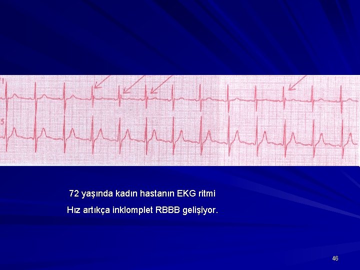 72 yaşında kadın hastanın EKG ritmi Hız artıkça inklomplet RBBB gelişiyor. 46 