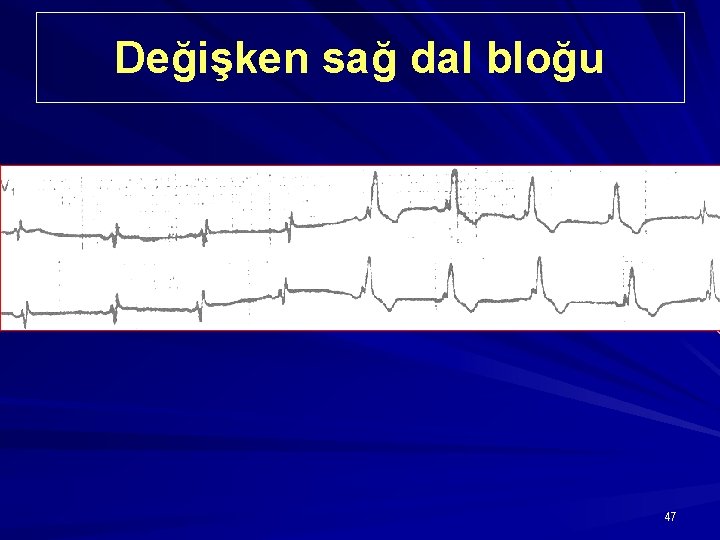 Değişken sağ dal bloğu 47 