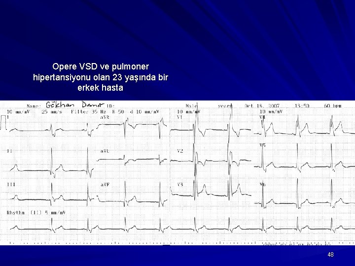 Opere VSD ve pulmoner hipertansiyonu olan 23 yaşında bir erkek hasta 48 