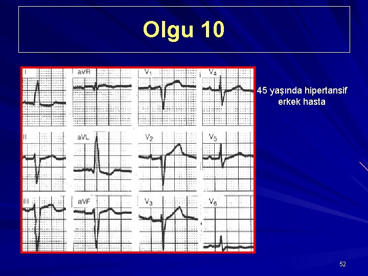 Olgu 10 45 yaşında hipertansif erkek hasta 52 