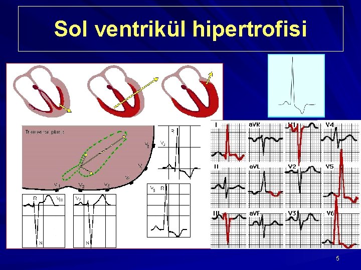 Sol ventrikül hipertrofisi 5 