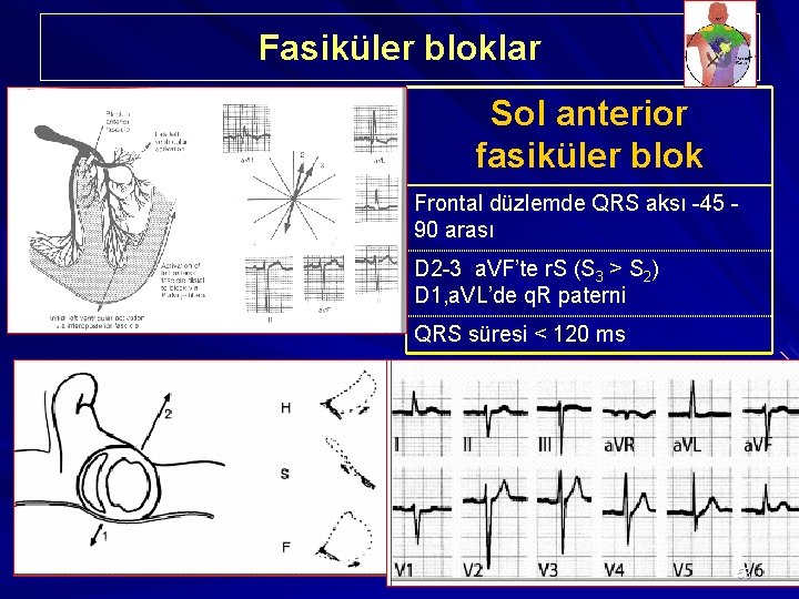 Fasiküler bloklar Sol anterior fasiküler blok Frontal düzlemde QRS aksı -45 90 arası D