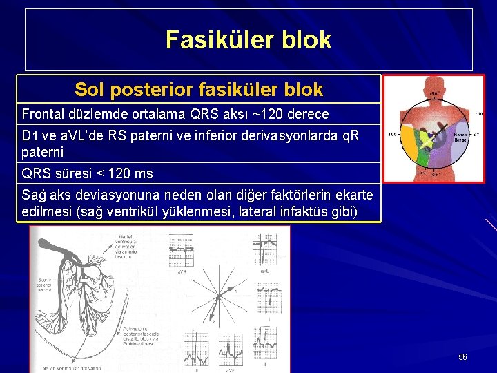 Fasiküler blok Sol posterior fasiküler blok Frontal düzlemde ortalama QRS aksı ~120 derece D