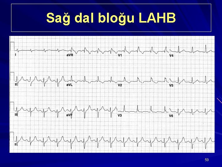 Sağ dal bloğu LAHB 59 