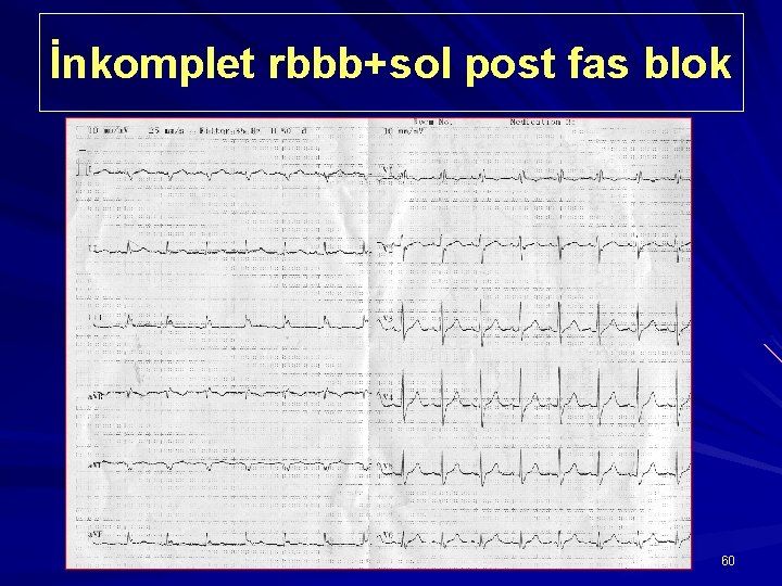 İnkomplet rbbb+sol post fas blok 60 