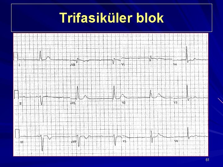 Trifasiküler blok 61 