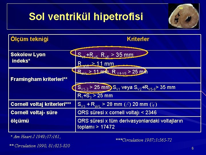 Sol ventrikül hipetrofisi Ölçüm tekniği Sokolow Lyon indeks* Kriterler SV 1+RV 5, RV 6