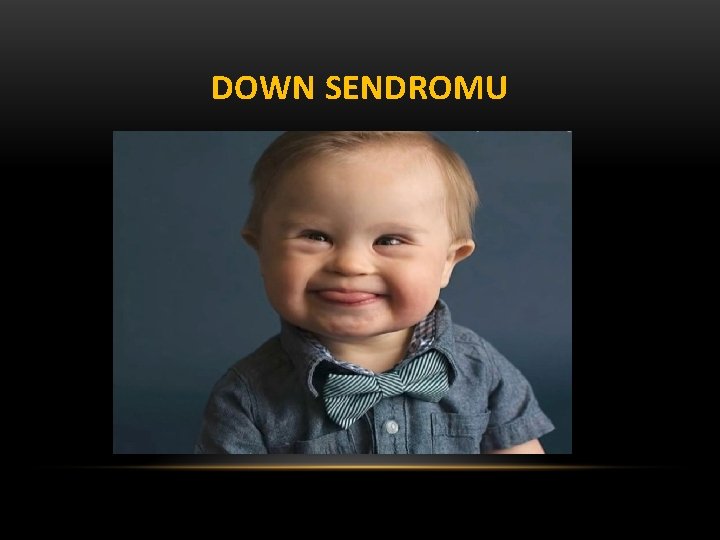 DOWN SENDROMU 