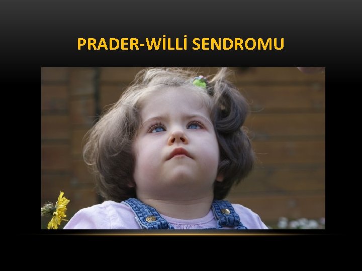 PRADER-WİLLİ SENDROMU 