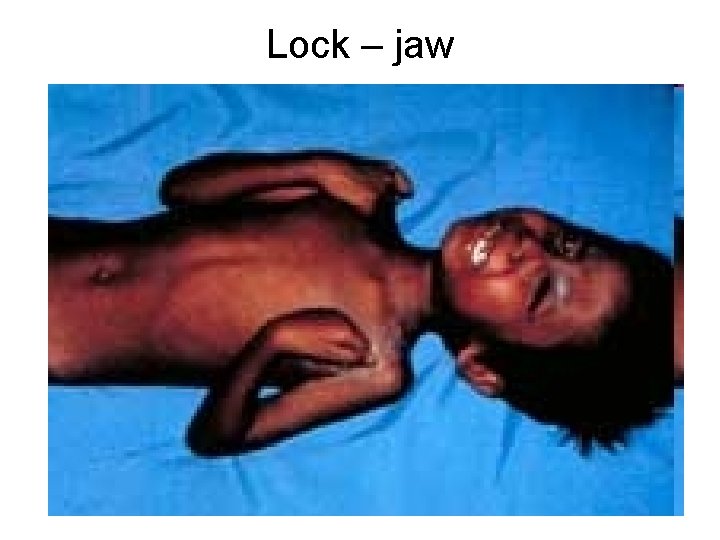 Lock – jaw 