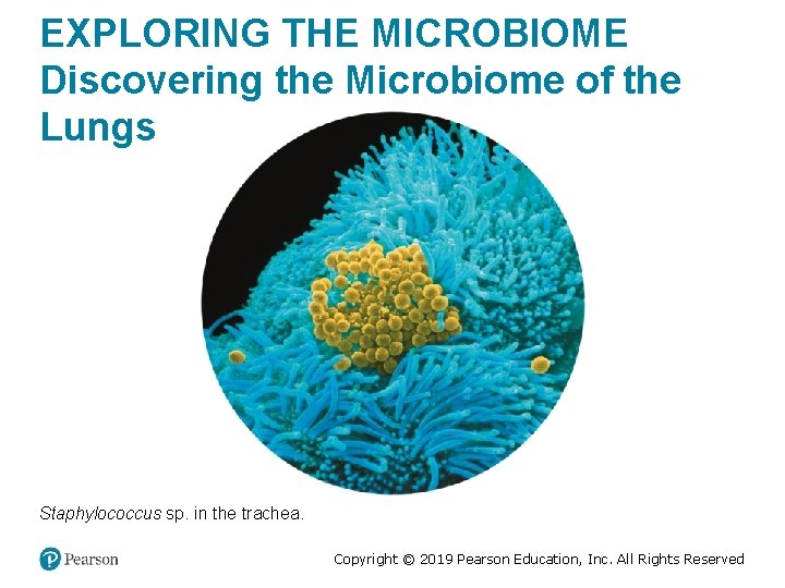 EXPLORING THE MICROBIOME Discovering the Microbiome of the Lungs Staphylococcus sp. in the trachea.