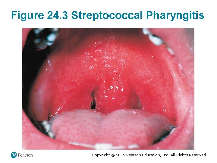 Figure 24. 3 Streptococcal Pharyngitis Copyright © 2019 Pearson Education, Inc. All Rights Reserved