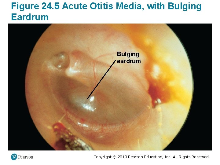 Figure 24. 5 Acute Otitis Media, with Bulging Eardrum Bulging eardrum Copyright © 2019
