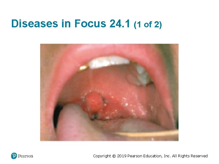 Diseases in Focus 24. 1 (1 of 2) Copyright © 2019 Pearson Education, Inc.