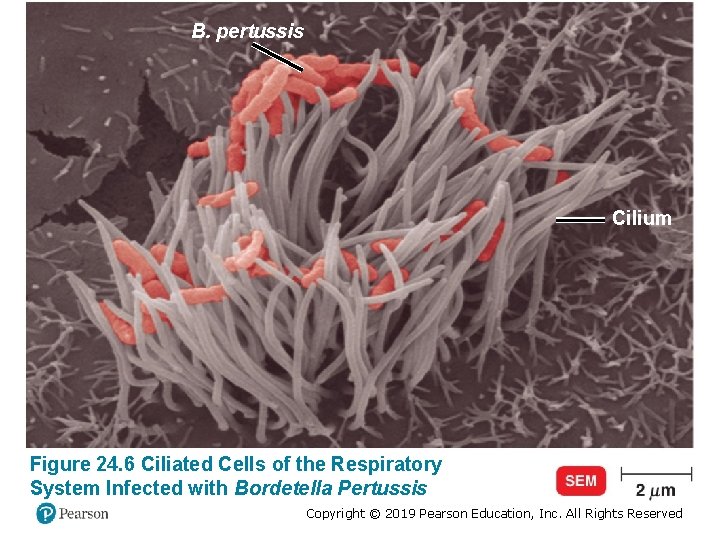 B. pertussis Cilium Figure 24. 6 Ciliated Cells of the Respiratory System Infected with