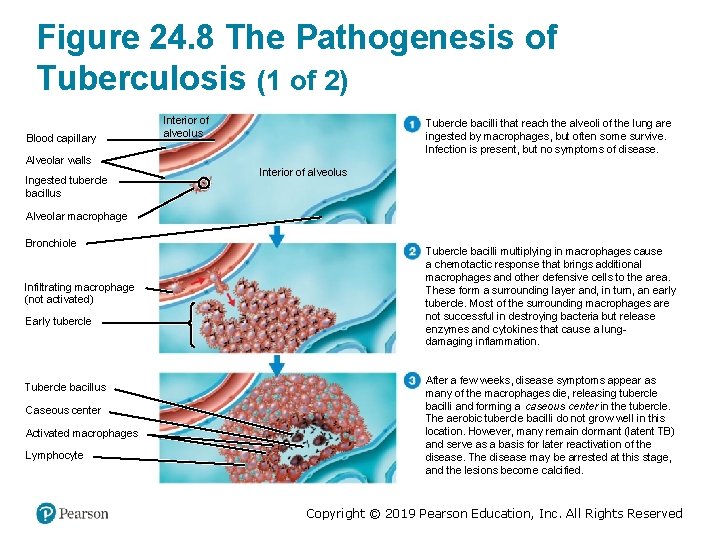 Figure 24. 8 The Pathogenesis of Tuberculosis (1 of 2) Blood capillary Interior of