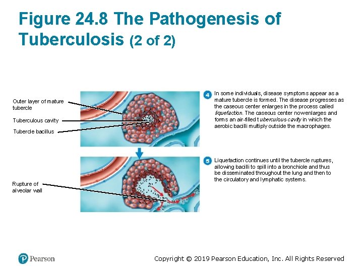 Figure 24. 8 The Pathogenesis of Tuberculosis (2 of 2) Outer layer of mature