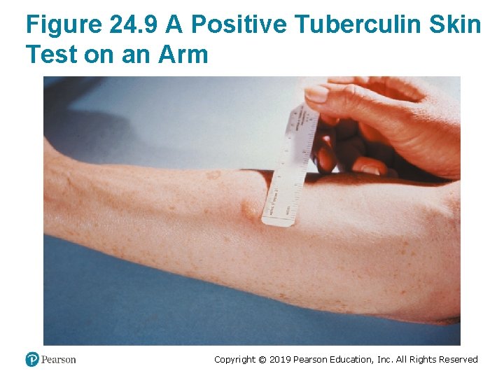 Figure 24. 9 A Positive Tuberculin Skin Test on an Arm Copyright © 2019