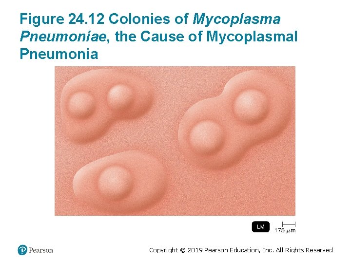 Figure 24. 12 Colonies of Mycoplasma Pneumoniae, the Cause of Mycoplasmal Pneumonia Copyright ©