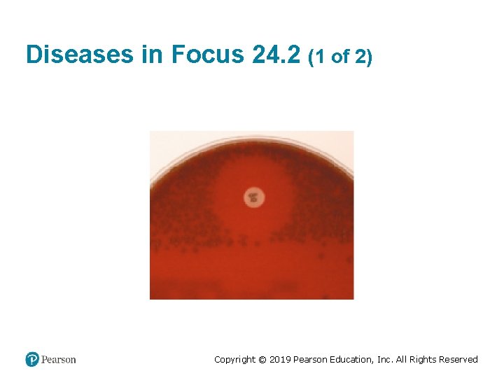 Diseases in Focus 24. 2 (1 of 2) Copyright © 2019 Pearson Education, Inc.