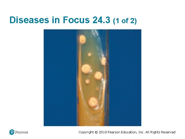 Diseases in Focus 24. 3 (1 of 2) Copyright © 2019 Pearson Education, Inc.