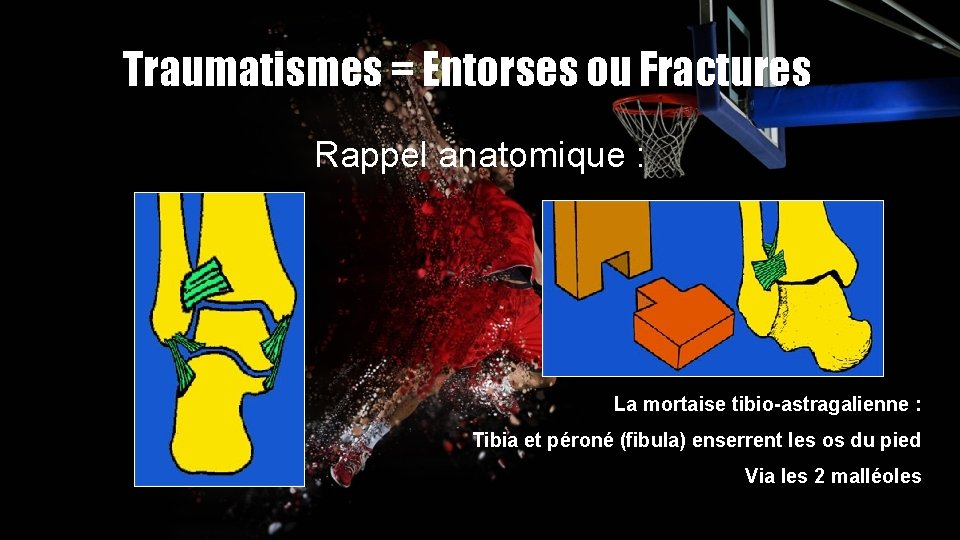 Traumatismes = Entorses ou Fractures Rappel anatomique : La mortaise tibio-astragalienne : Tibia et