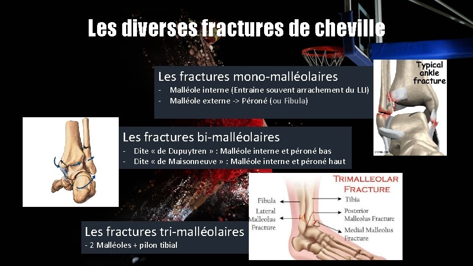 Les diverses fractures de cheville Les fractures mono-malléolaires - Malléole interne (Entraine souvent arrachement