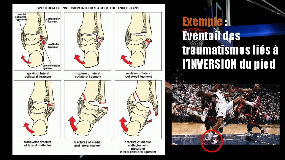 Exemple : Eventail des traumatismes liés à l’INVERSION du pied 