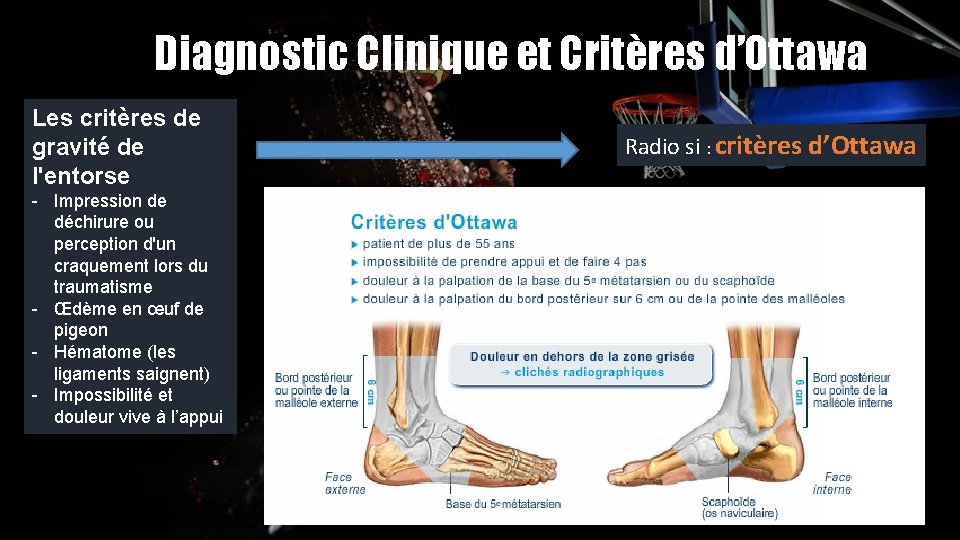 Diagnostic Clinique et Critères d’Ottawa Les critères de gravité de l'entorse - Impression de