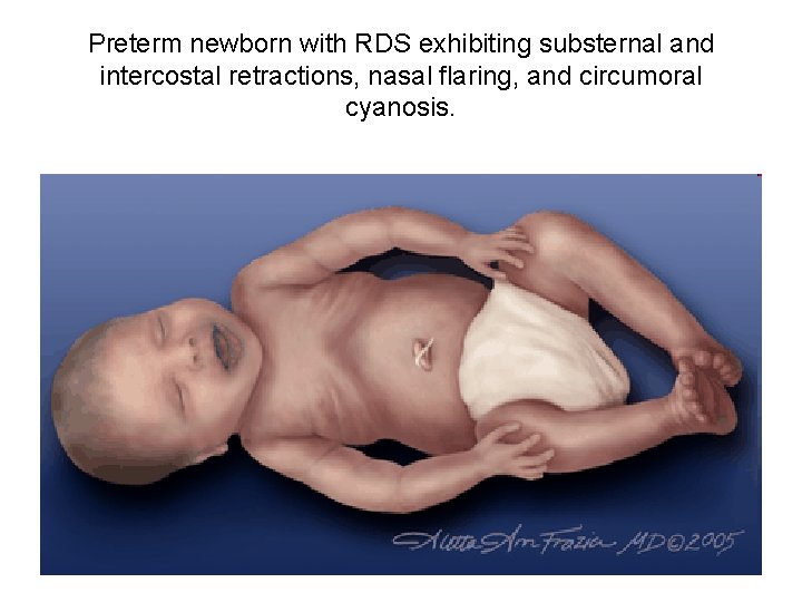 Preterm newborn with RDS exhibiting substernal and intercostal retractions, nasal flaring, and circumoral cyanosis.