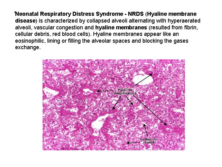 . Neonatal Respiratory Distress Syndrome - NRDS (Hyaline membrane disease) is characterized by collapsed