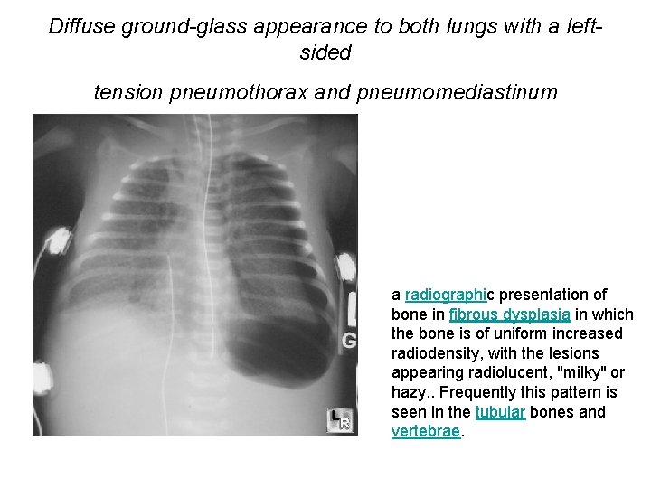 Diffuse ground-glass appearance to both lungs with a leftsided tension pneumothorax and pneumomediastinum a