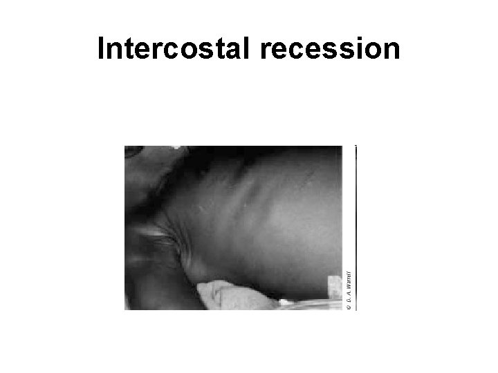 Intercostal recession 