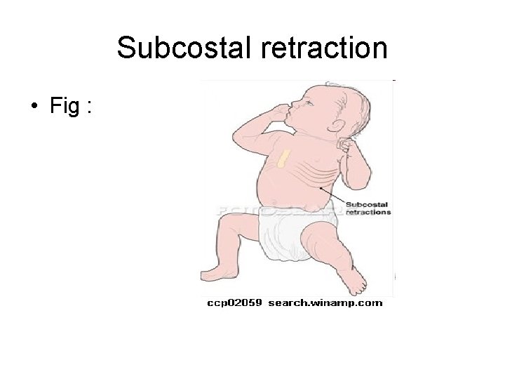 Subcostal retraction • Fig : 