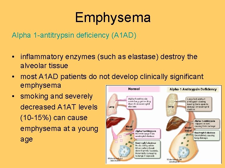 Emphysema Alpha 1 -antitrypsin deficiency (A 1 AD) • inflammatory enzymes (such as elastase) Emphysema Alpha 1 -antitrypsin deficiency (A 1 AD) • inflammatory enzymes (such as elastase)