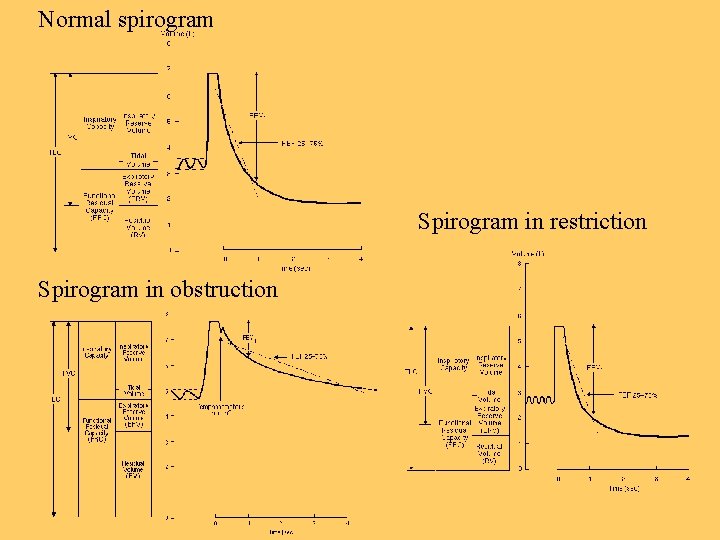 Normal spirogram Spirogram in restriction Spirogram in obstruction Normal spirogram Spirogram in restriction Spirogram in obstruction