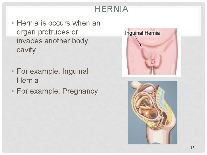 HERNIA • Hernia is occurs when an organ protrudes or invades another body cavity.