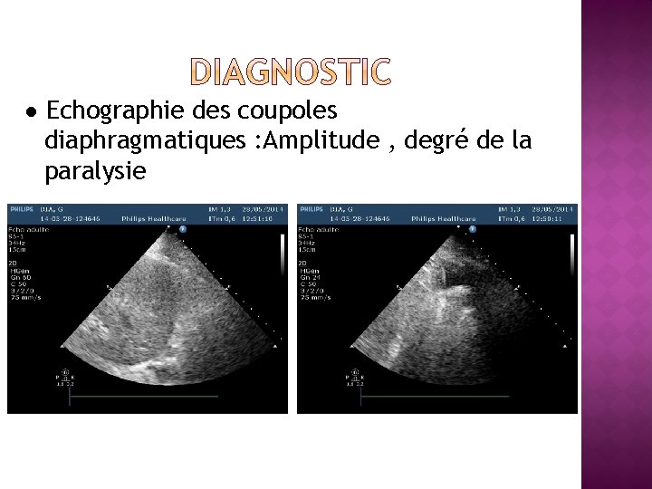 ● Echographie des coupoles diaphragmatiques : Amplitude , degré de la paralysie 