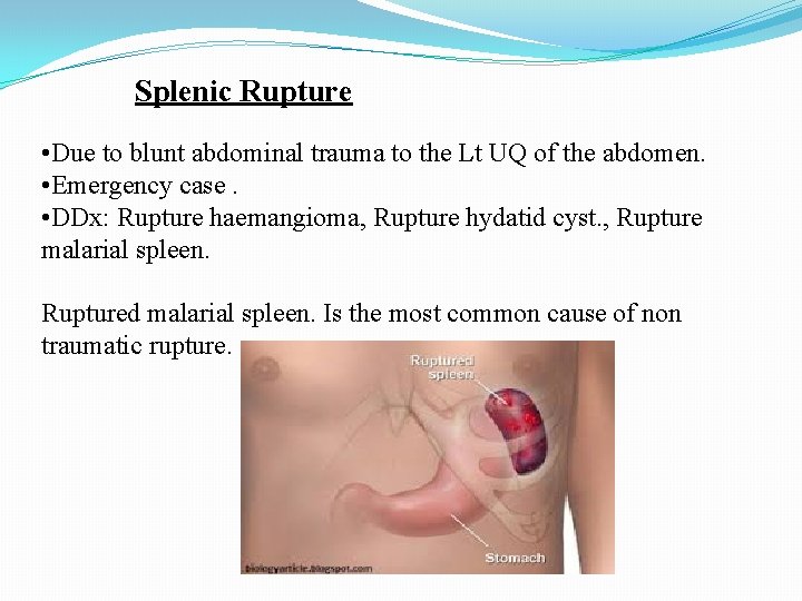 Splenic Rupture • Due to blunt abdominal trauma to the Lt UQ of the