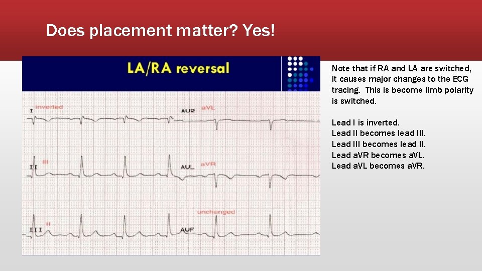 Does placement matter? Yes! Note that if RA and LA are switched, it causes