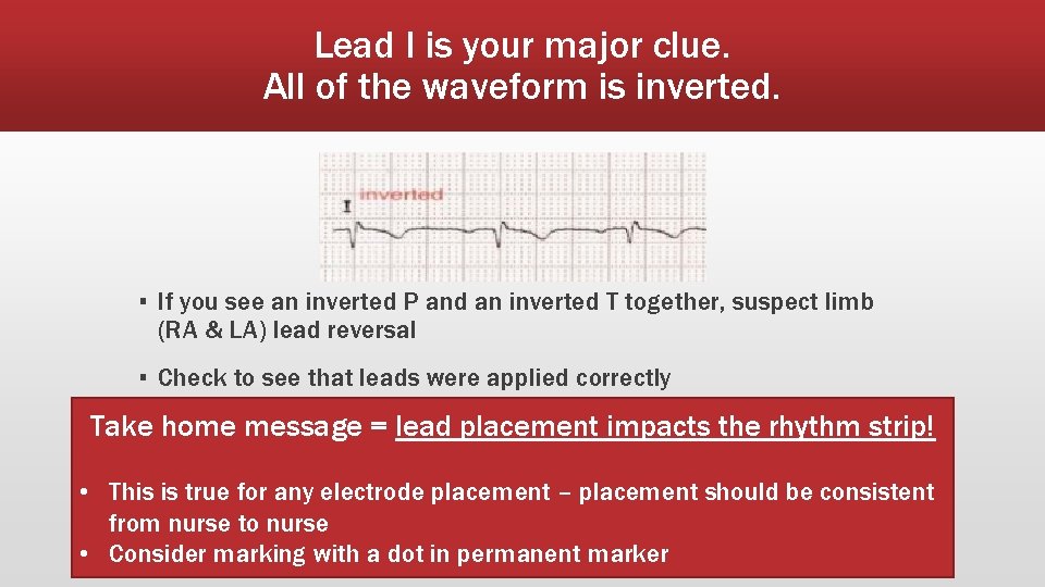 Lead I is your major clue. All of the waveform is inverted. ▪ If